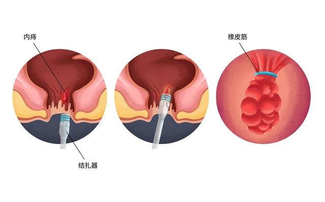 男人还要用卫生巾？日本发明男用卫生巾热卖，并已进入中国市场